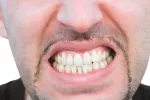 Bruxismo Bruxismo