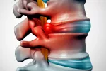 Hernia discal Hernia discal