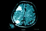 Tumor cerebral Tumores cerebrales