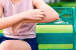 Qué es la enfermedad de Chagas Mujer rascándose el brazo por chinches que transmiten la enfermedad de Chagas
