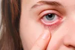 Ojo con síntomas de escleritis