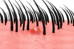 Foliculitis o pelos encarnados