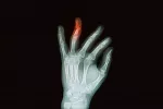 Fractura de dedo Radiografía de fractura de dedo