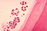 Hidatidosis Hidatidosis