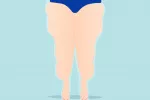 Lipedema, grasa patológica Mujer con lipedema