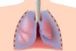 Neumotórax, afectación de los pulmones Neumotórax