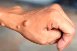 Neurofibromatosis Neurofibromatosis