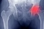Qué es la osteonecrosis Osteonecrosis
