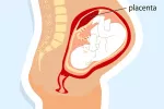 Qué es la placenta accreta Placenta accreta