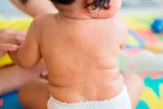 Roseola
