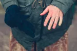 Sabañones, cómo evitar estas lesiones causadas por el frío Persona con sabañones en las manos