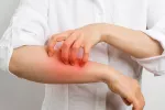 Sarcoptes scabei Sarna o escabiosis