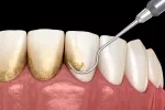 Sarro dental, cómo evitar y eliminar la placa Sarro dental