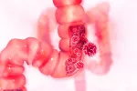 Sibo, exceso de bacterias en el intestino delgado Sibo, exceso de bacterias en el intestino delgado