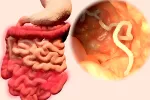 Teniasis Ilustración de una tenia en el intestino