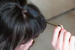 Tricotilomanía Persona con tricotilomanía