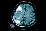 Qué son los tumores cerebrales Qué son los tumores cerebrales