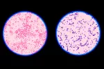 Diagnóstico de la vaginosis bacteriana Diagnóstico para tratar la vaginosis bacteriana