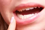 Determinan los alimentos que ayudan a reducir el riesgo de gingivitis Mujer con problemas de gingivitis