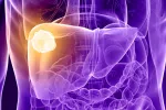 Proteína p38g, nueva diana para tratar el cáncer de hígado Infografía de un cáncer de hígado