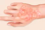 Europa aprueba risankizumab para tratar la psoriasis en placas Mano con problemas de psoriasis en placas