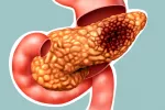 Una nueva terapia retrasa la progresión del cáncer de páncreas Cáncer de páncreas