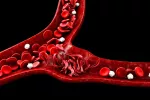 Tener anemia podría aumentar el riesgo de alzhéimer y otras demencias Anemia