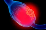 Nuevos fármacos para tratar el cáncer de ovario
