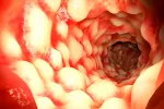 Tratamiento para las fístulas de la enfermedad de Crohn