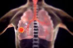 Cáncer de pulmón Infografía del áncer de pulmón