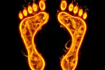 Síndrome de pies ardientes, ‘fuego’ en las extremidades Síndrome de pies ardientes
