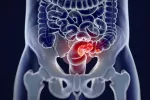 Síndrome de Lynch Síndrome de Lynch: cáncer colorrectal hereditario no polipósico