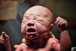 Bebé con el síndrome de dificultad respiratoria neonatal
