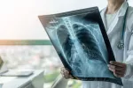 Radiografía que muestra una infección pulmonar