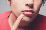 Virus del herpes Virus herpes