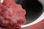 Primer fármaco eficaz contra un tumor gastrointestinal mortal Primer fármaco eficaz contra un tumor gastrointestinal