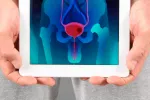 La técnica HIFU contra el cáncer de próstata, eficaz y poco invasiva La técnica HIFU contra el cáncer de próstata