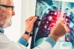 SDRA, neumonía y sepsis, complicaciones por COVID-19 más frecuentes SDRA, neumonía y sepsis, complicaciones por coronavirus más frecuentes