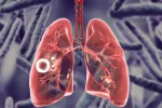 Una vacuna española contra la tuberculosis puede sustituir a la actual Vacuna Mtbvac eficaz contra tuberculosis