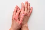Hallan el posible origen del desarrollo de la psoriasis y el eccema Psoriasis y eccema: hallan su origen