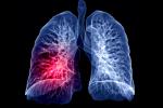 Secuelas respiratorias pos-COVID-19
