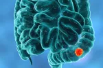 Hallan nuevas dianas terapéuticas para frenar el cáncer colorrectal Posible diana contra cáncer colorrectal