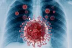 La tuberculosis es más grave con coinfección de COVID-19 Tuberculosis con coinfección de COVID-19