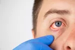 Conjuntivitis, lo mejor para aliviarla