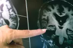 La infección por VIH reduce la materia blanca del cerebro Imágenes del cambio en la materia blanca del cerebro