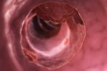 Biomarcadores para diagnosticar el cáncer de colon 