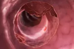 Nuevos biomarcadores para diagnosticar el cáncer de colon metastásico Biomarcadores para diagnosticar el cáncer de colon
