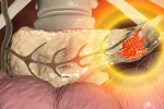 Perfeccionan el diagnóstico de tumores de páncreas y de vías biliares Tumor de páncreas