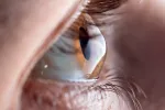 Abrasión corneal Abrasión corneal: cómo actuar