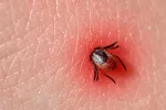 Desarrollan una vacuna ARNm prometedora contra la enfermedad de Lyme Enfermedad de Lyme: vacuna prometedora
